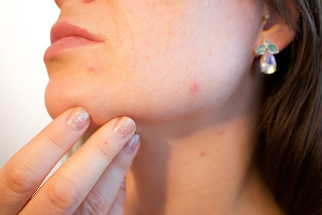 ACNE, a casi todos nos toca en algún momento